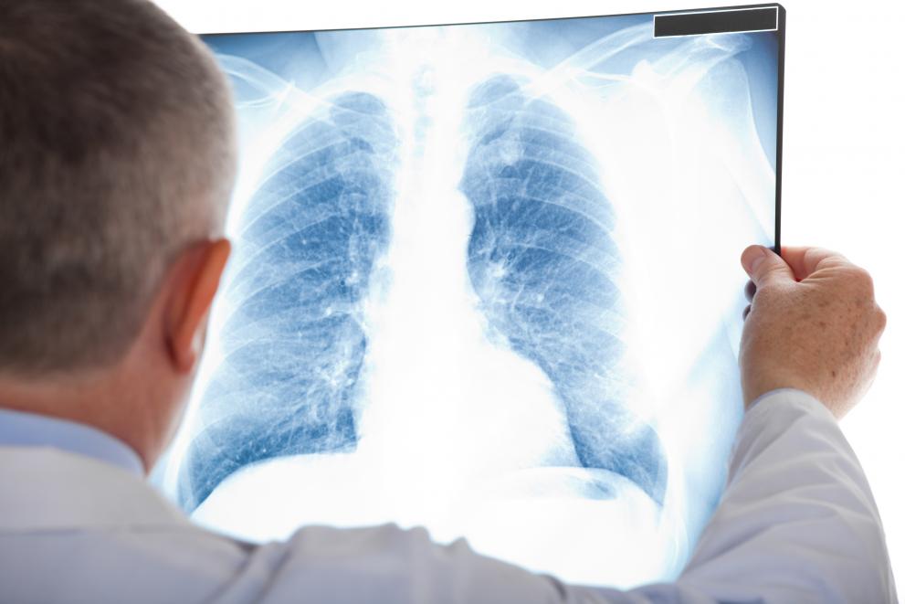 Scientists were able to highlight important variations in lung cancer burden across Europe’s regions